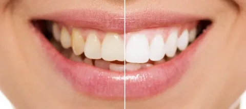 Everything You Need to Know About Cosmetic Dental Whitening in Dubai